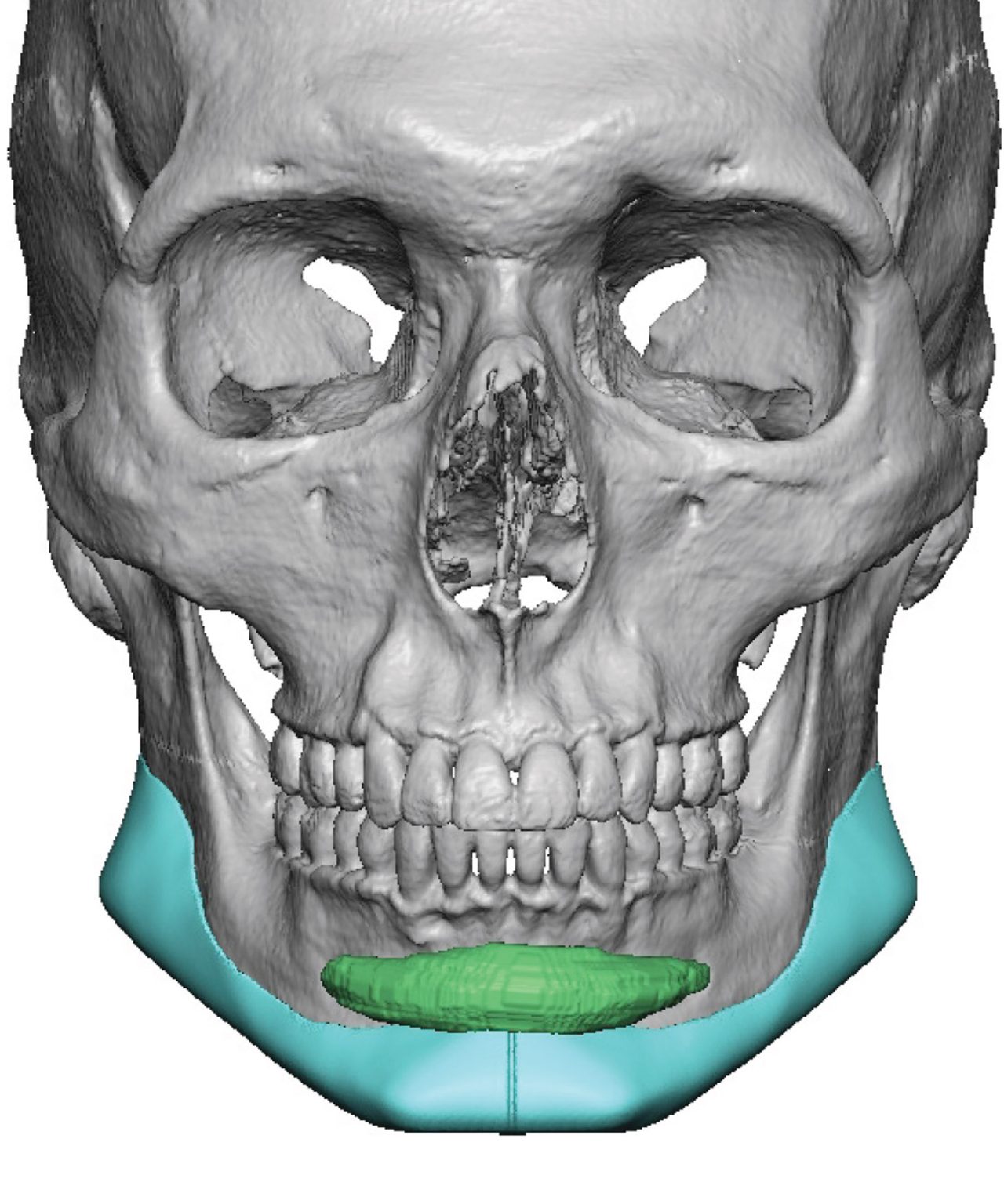 Plastic Surgery Case Study - Custom Jawline Implant Design Leaving ...