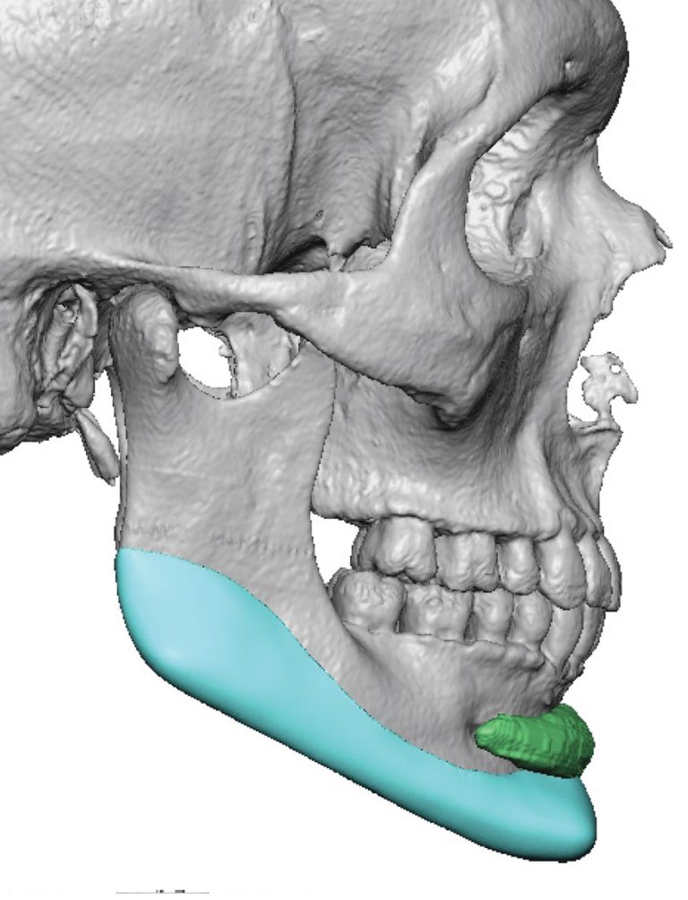 Plastic Surgery Case Study - Custom Jawline Implant Design Leaving ...