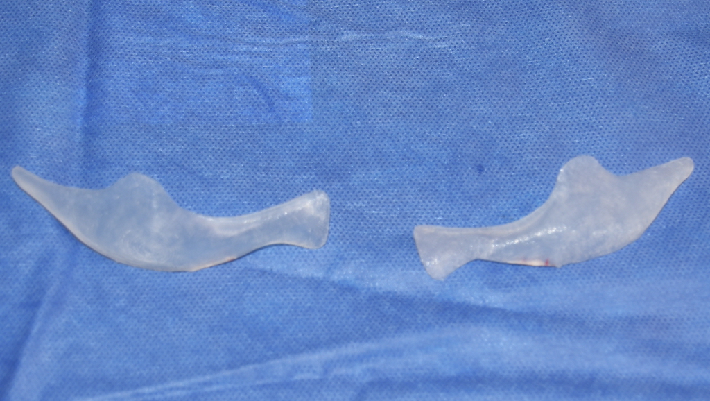 custom IOM implants intraop Dr Barry Eppley - Explore Plastic Surgery