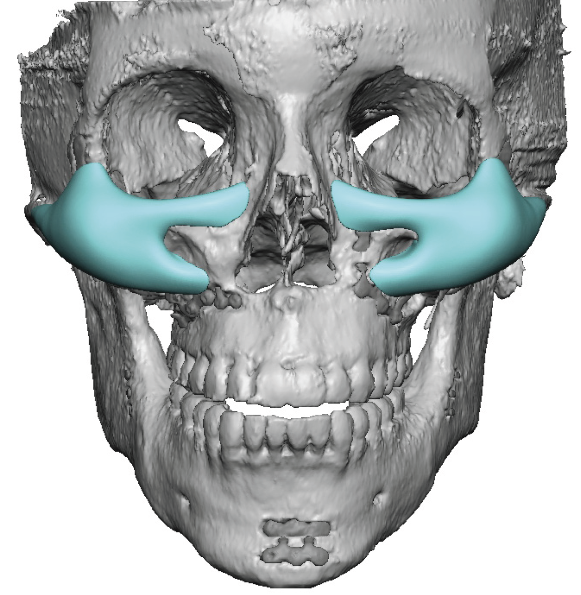 Plastic Surgery Case Study - Custom Infraorbital-Malar-Maxillary ...