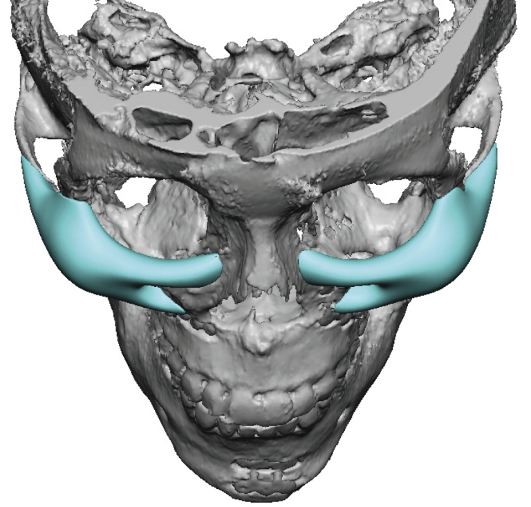 Plastic Surgery Case Study - Custom Infraorbital-Malar-Maxillary ...