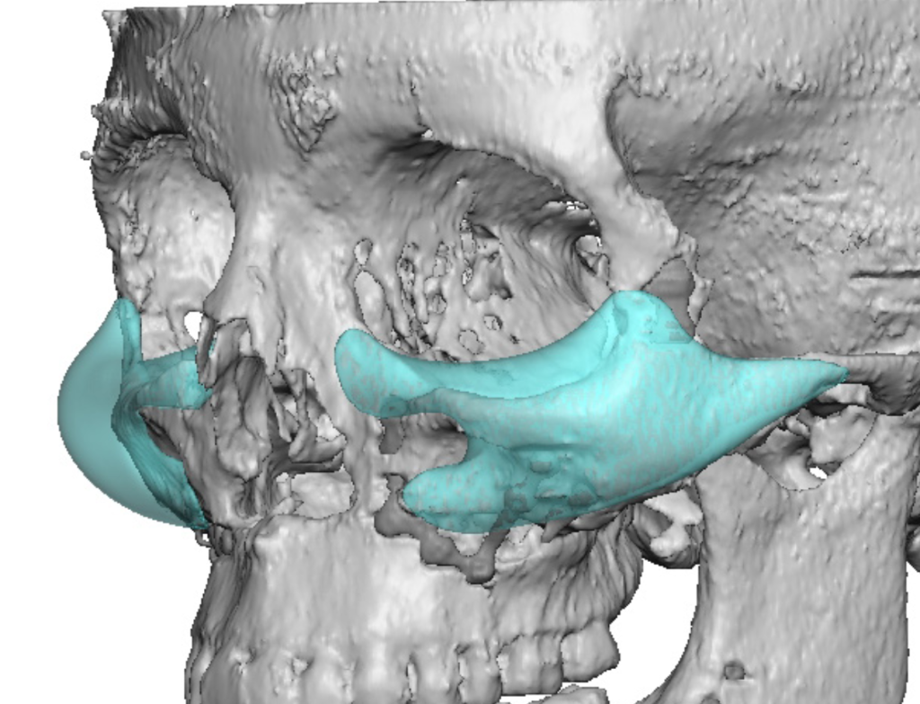 Plastic Surgery Case Study - Custom Infraorbital-Malar-Maxillary ...