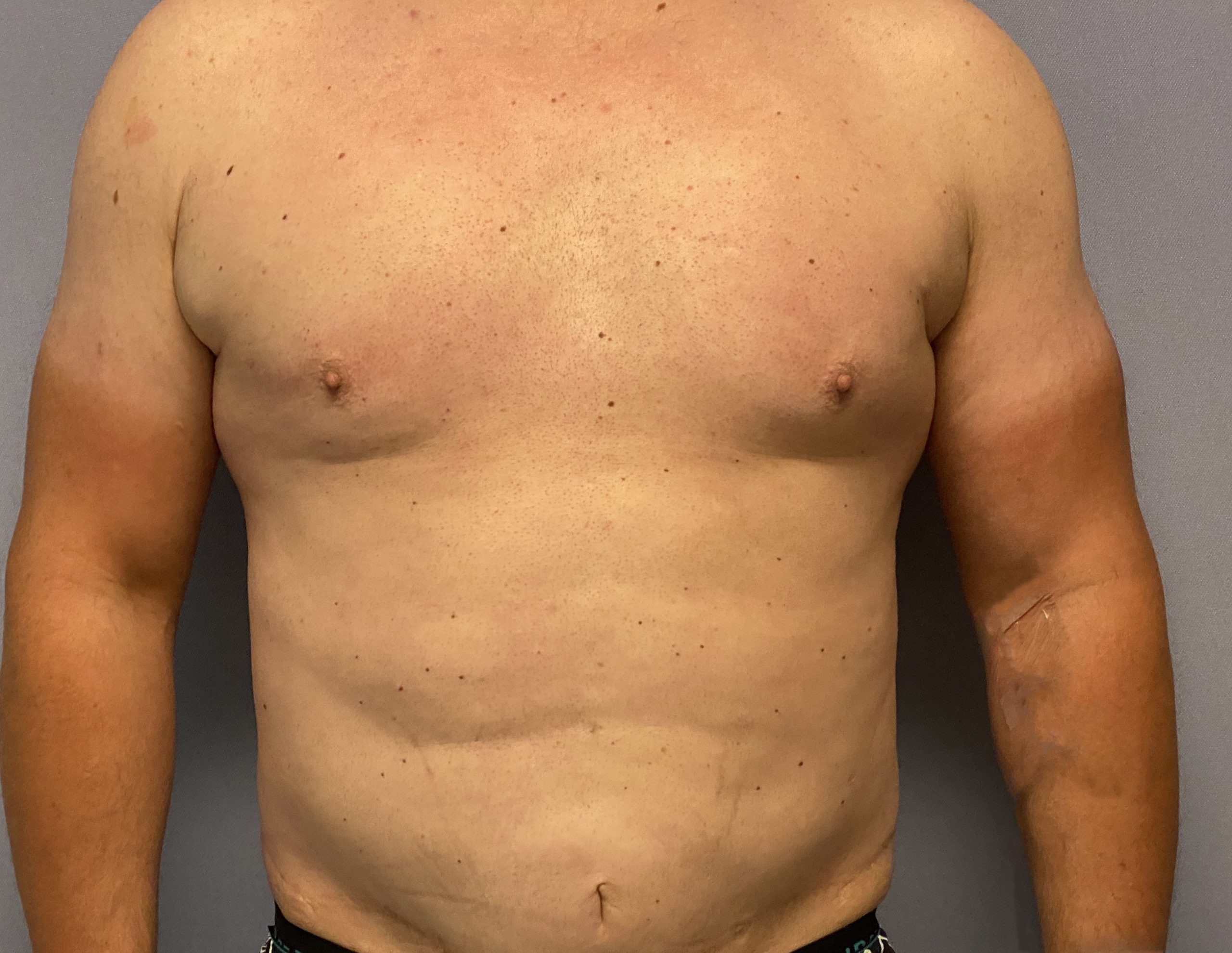 male tummy tuck ab implants frnt 1 Dr Barry Eppley Explore Plastic