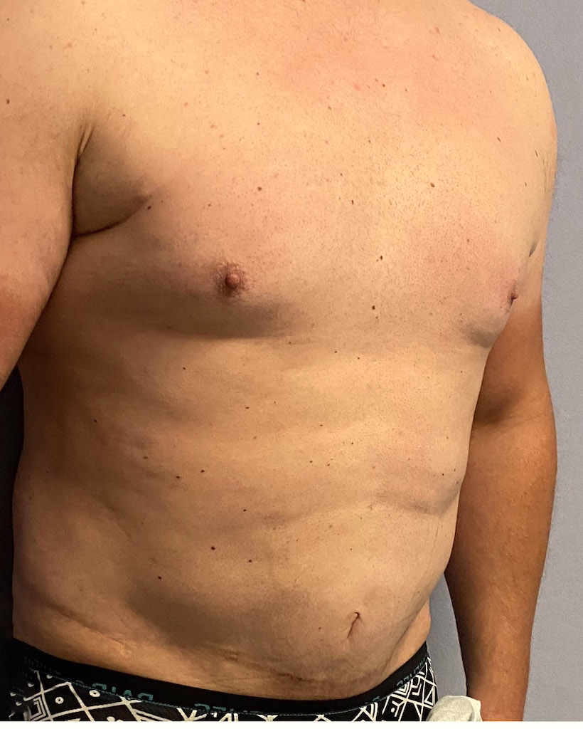 Plastic Surgery Case Study Abdominal Implants in the Male Tummy Tuck