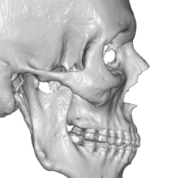 jaw angle implant Archives - Explore Plastic Surgery