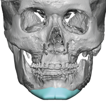 buccal lipectomy Archives - Explore Plastic Surgery