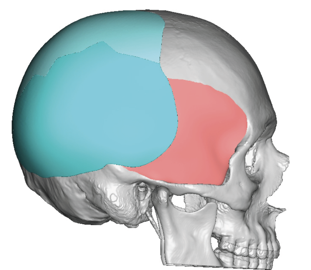 2 piece right plagiocephaly skull implant design side view Dr Barry ...