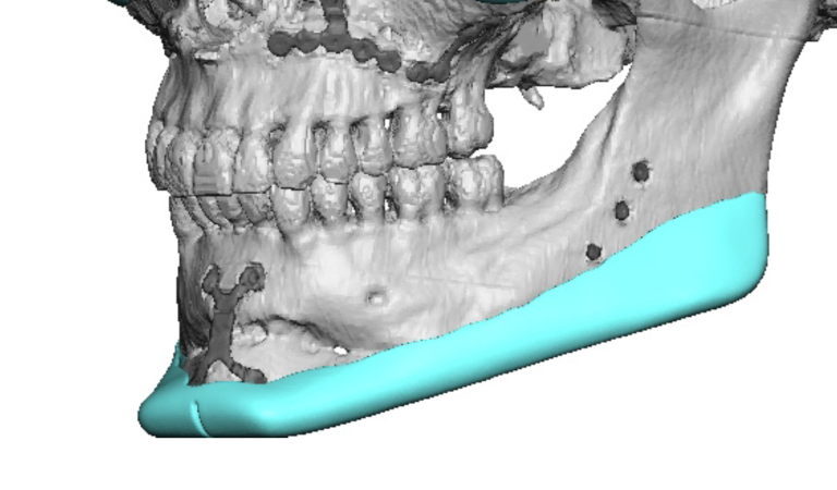 custom jawline enhacement implant design oblique view Dr Barry Eppley ...