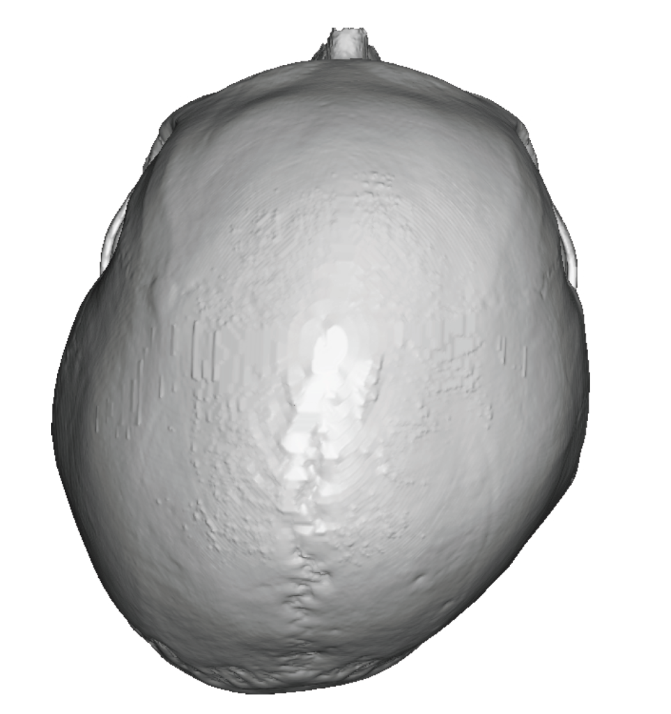 right plagiocephaly 3D CT scan top view Dr Barry Eppley - Explore ...