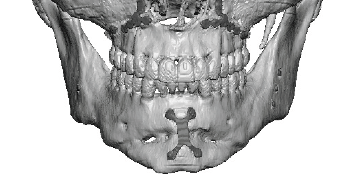 vertical chin lengthening result front view 3D CT scan Dr Barry Eppley ...