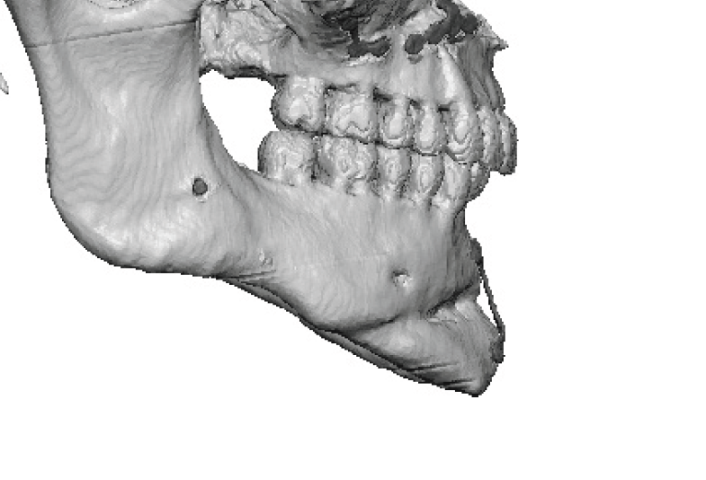 vertical chin lengthening result side view 3D CT scan Dr Barry Eppley ...