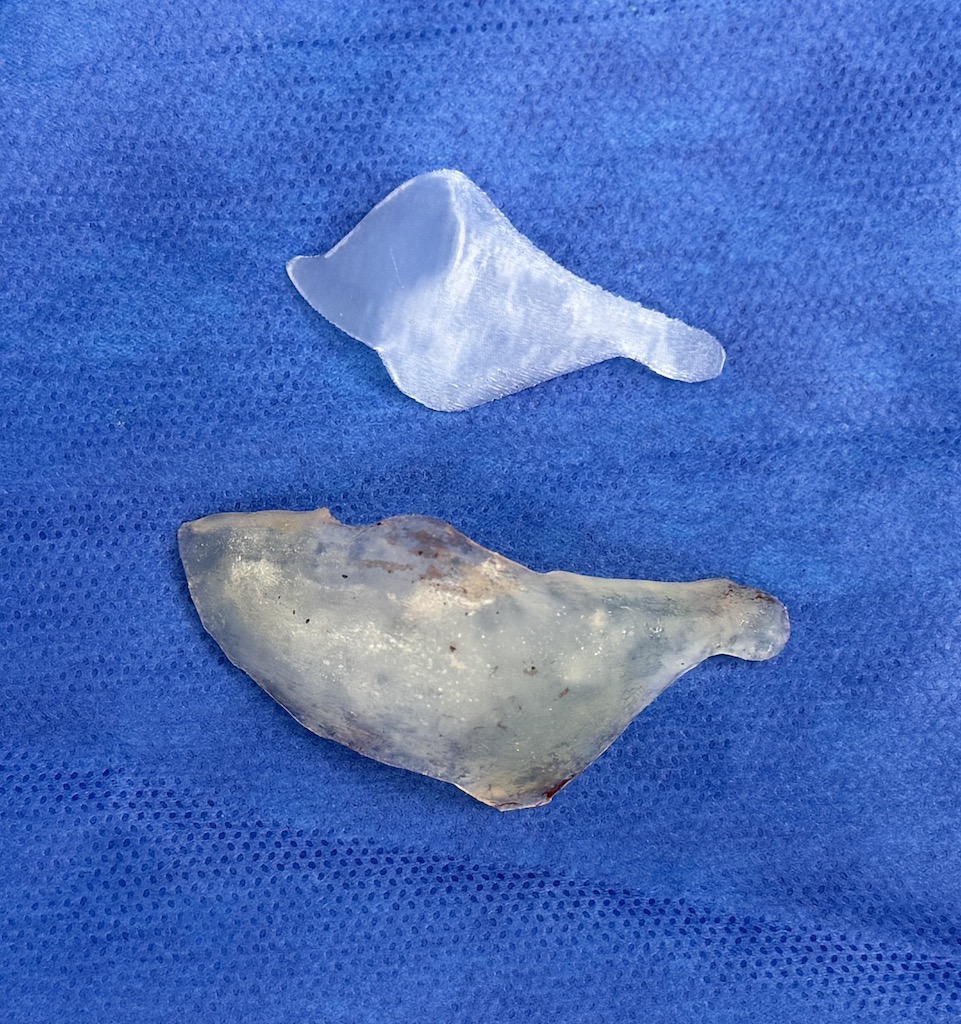 New custom Infraorbital-malar implant Dr Barry Eppley - Explore Plastic ...