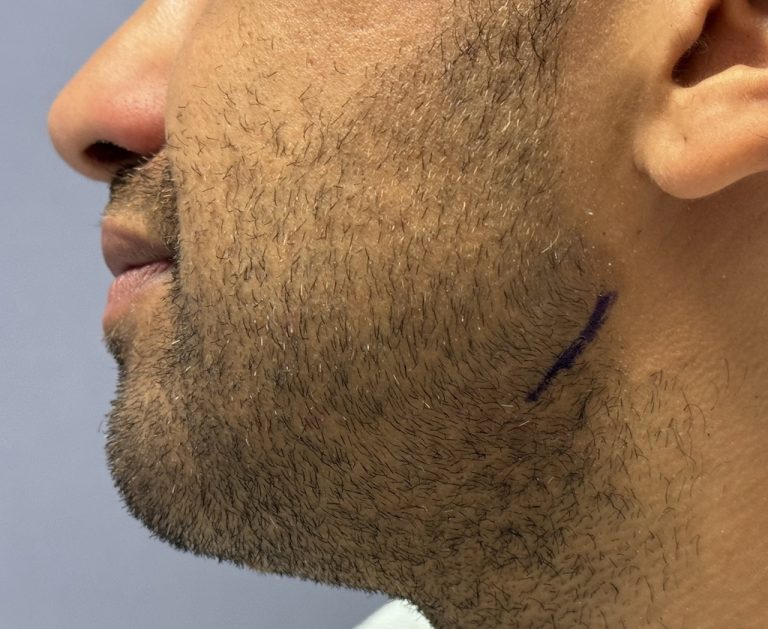Technical Strategies - Direct Transcutaneous Approach to Jaw Angle ...