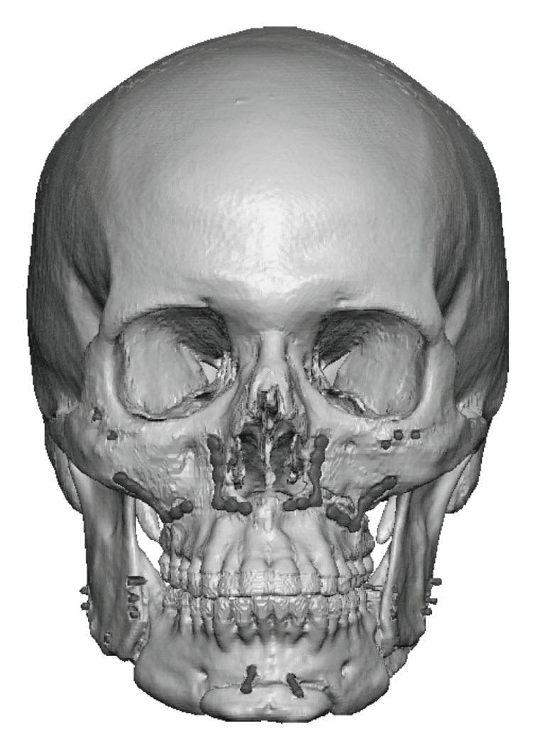 bimax surgery 3D CT scan front view Dr Barry Eppley Explore Plastic Surgery