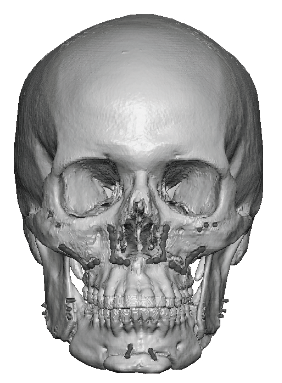 Plastic Surgery Case Study - Custom Jawline Implant for Correction of ...