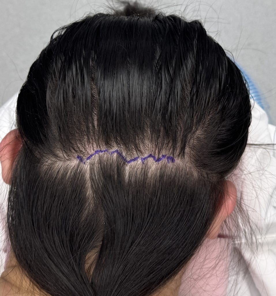 Plastic Surgery Case Study Custom Back Of Head Skull Implant In The Long Haired Flat Back Of