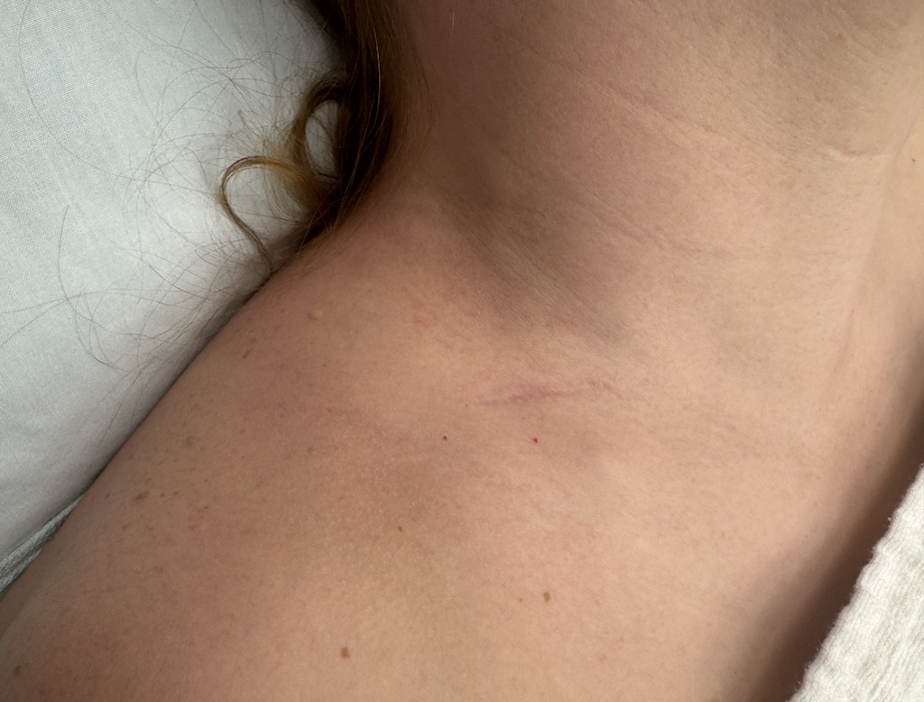 Plastic Surgery Case Study - Long Term Scar and Bone Healing from ...