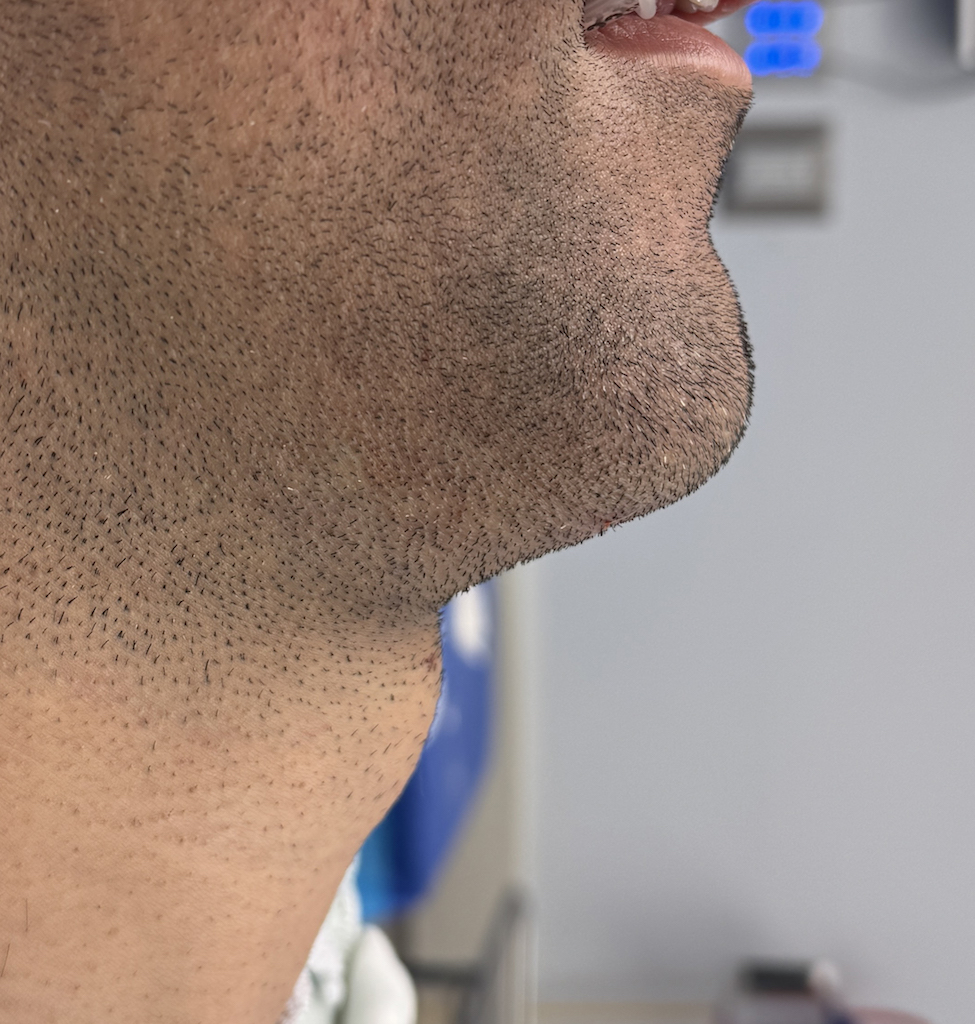 male custom chin implant intraop side 2 Dr Barry Eppley - Explore ...