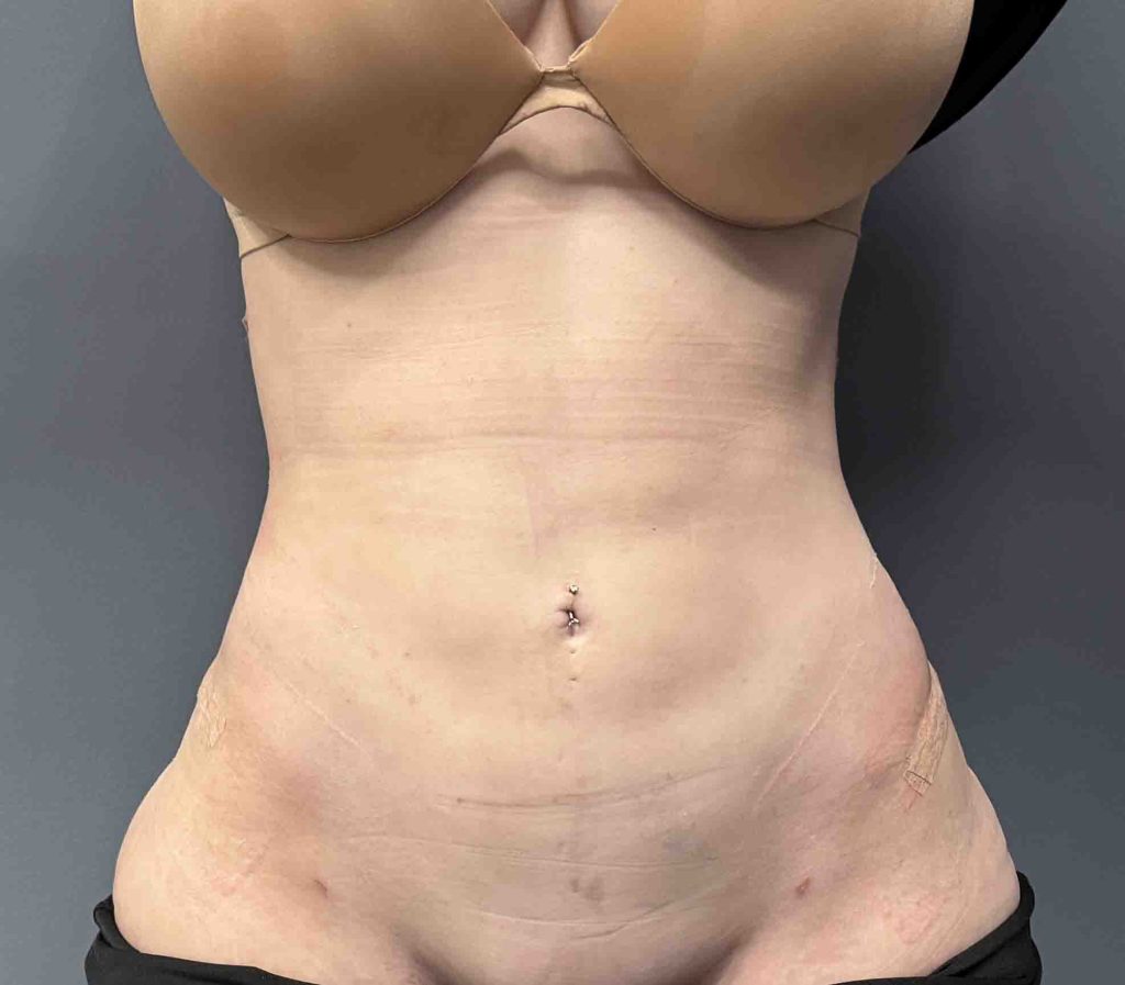 Rib Removal with Anterior Rib #10 Prominence Reductions Case Study ...