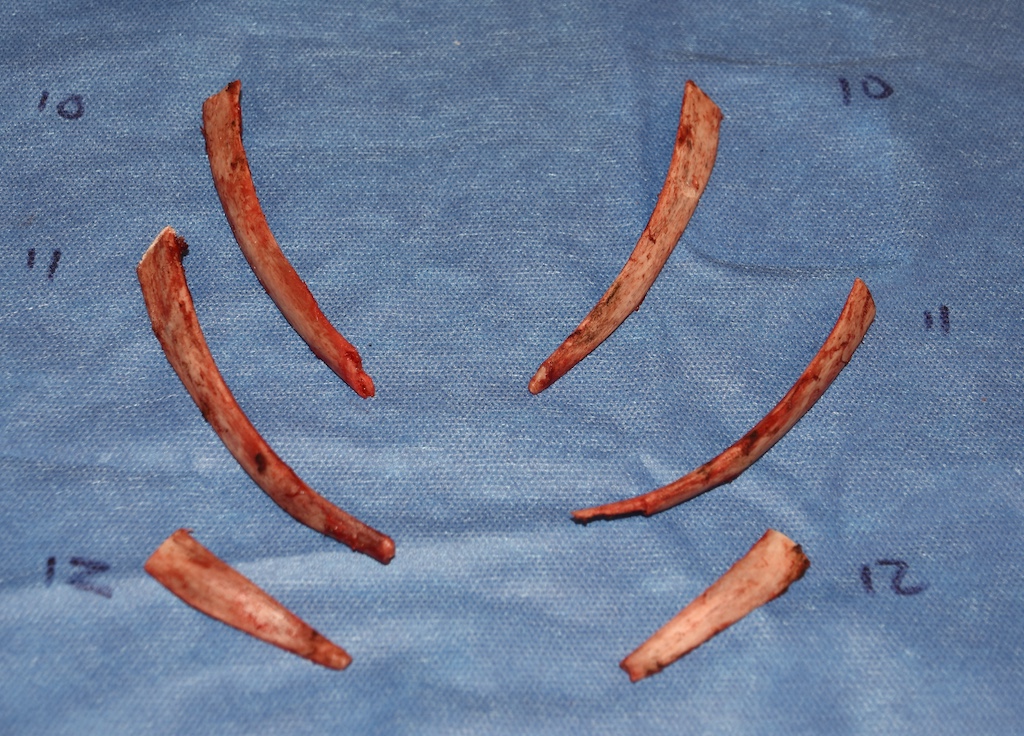 Rib Removal Surgery – Patient Frequently Asked Questions - Explore ...