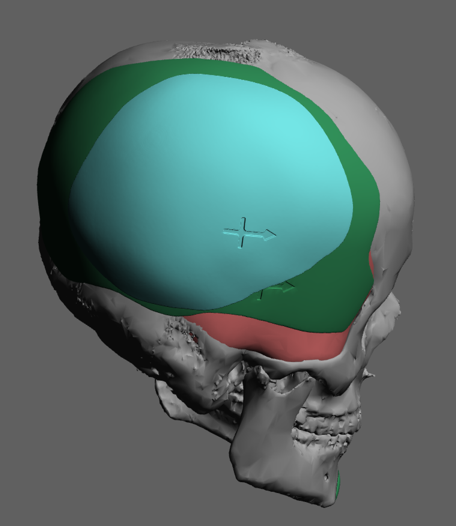 Custom Occipital-Parietal Temporal Skull Implant Overlay Case Example ...